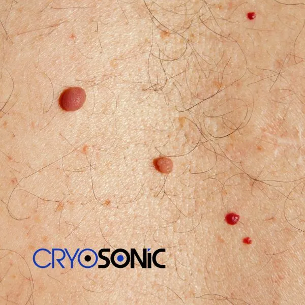 get cherry angioma removal treatment today! Blackburn