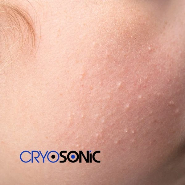 Are you looking for milia removal treatment? Contact our team today Blackburn
