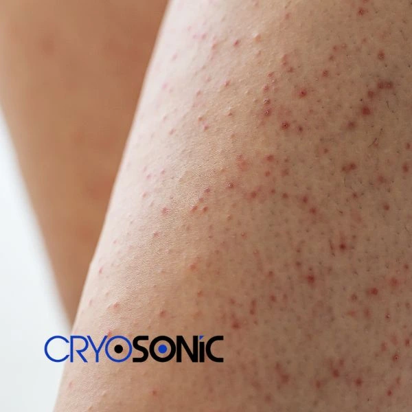 Looking for Seborrhoeic Keratosis removal Blackburn treatment? Call our consultants today in Blackburn