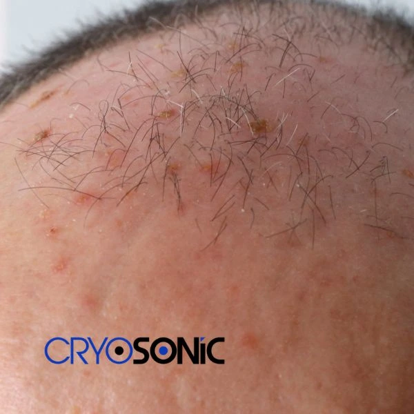 Access Seborrhoeic Keratosis removal from the comfort of your own home! Call us today in Blackburn