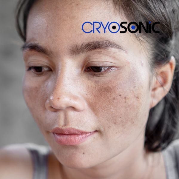 Ready to start age spots removal? Contact our team today in Blackburn