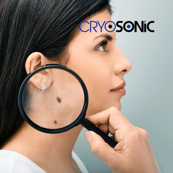 Do you want to learn more about benign moles removal treatment? Call our team today Blackburn