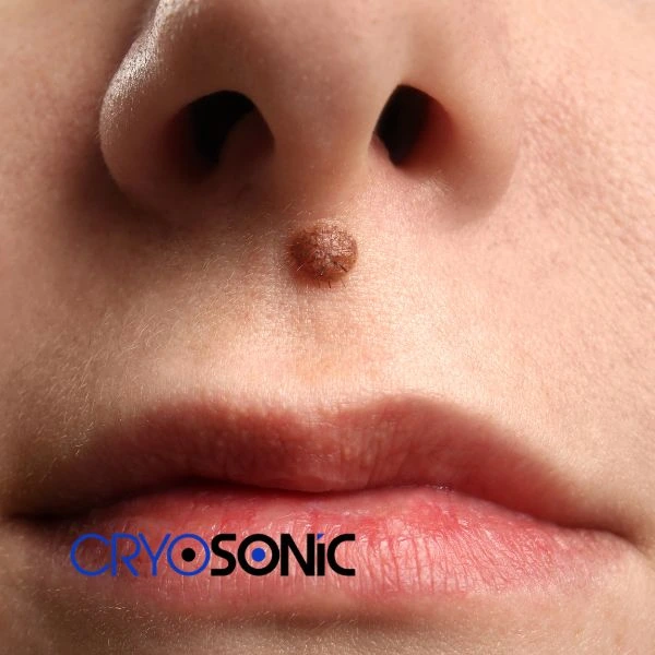 Start your benign moles removal treatment today Blackburn