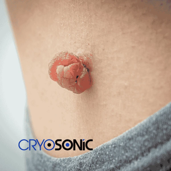Book your skin tags removal Blackburn from comfort of your own home! Blackburn