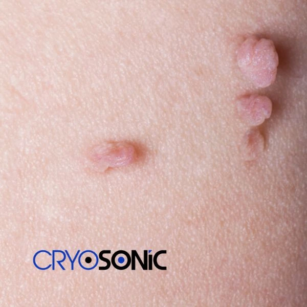 Are you looking for fast effect skin tag removal Blackburn? Book in NOW! Blackburn