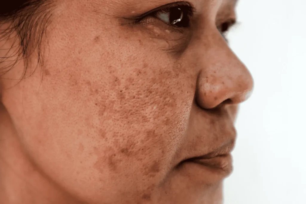 Cryosonic Repair Sun-Damaged Skin Blackburn Blackburn