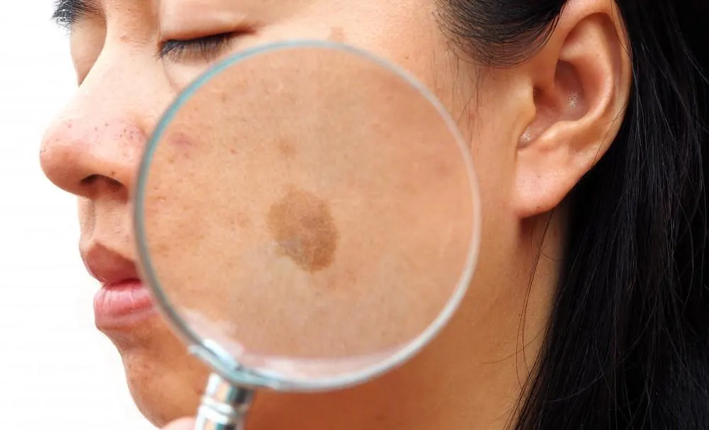 How Seborrheic Keratosis Blackburn appears on the skin Blackburn