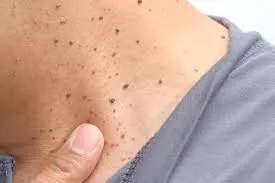 Seborrheic Keratosis: Understanding Skin Changes and CryoPen Treatment Options Blackburn