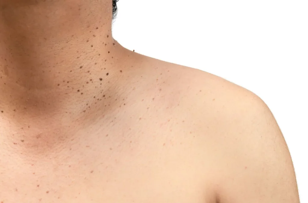 How to Maintain Healthy Skin After Treatment Blackburn? Blackburn