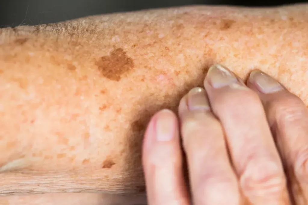 Why Is Early Treatment of Sun Damage Important Blackburn? Blackburn