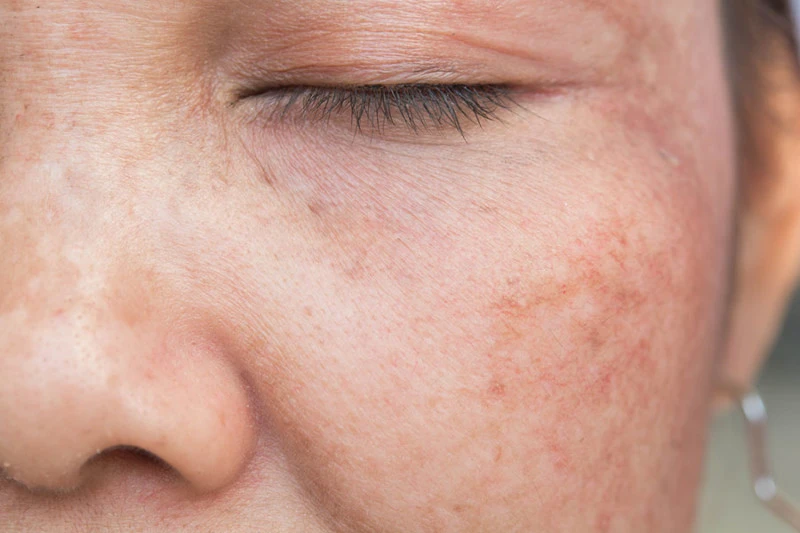 UV rays affecting skin cells, showing sun damage and the need for Cryosonic repair treatments Blackburn. Blackburn