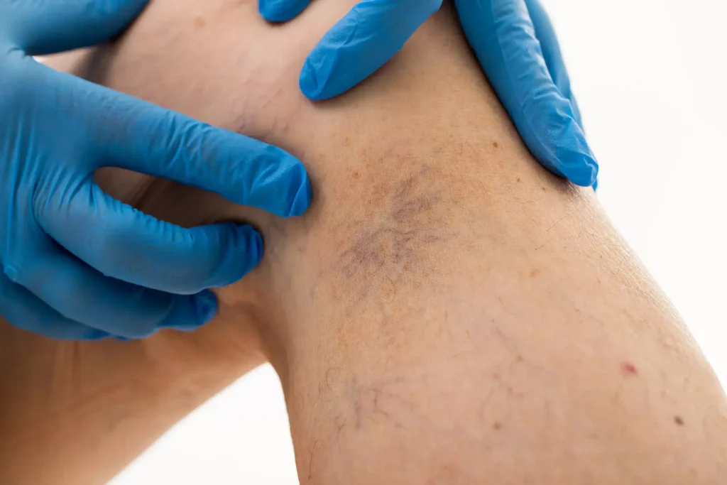 Spider Veins vs. Spider Angiomas: Understanding the Differences in CryoPen Blackburn