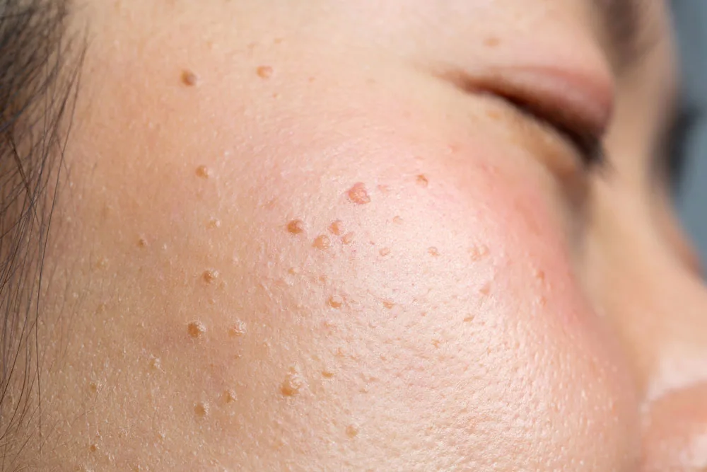 Why Choose CryoPen for Seborrheic Keratosis Blackburn Blackburn