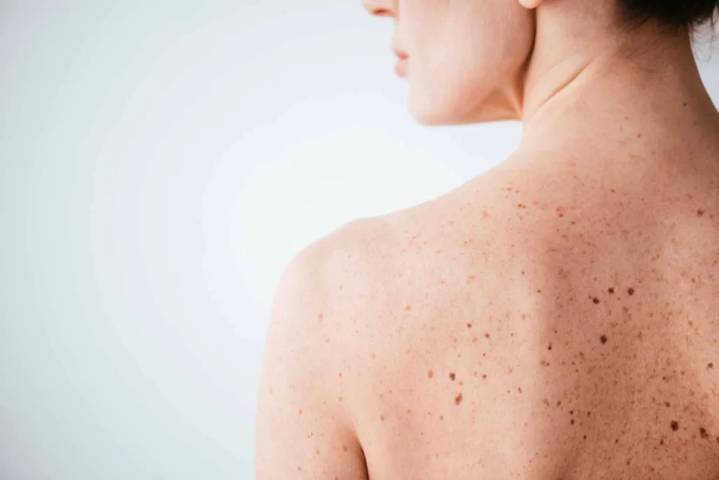 Sun Damage : Understanding UV Effects and Skin Repair Options Blackburn